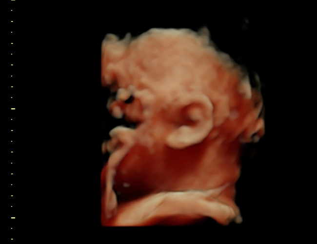 3D ultrasound image at 31 weeks